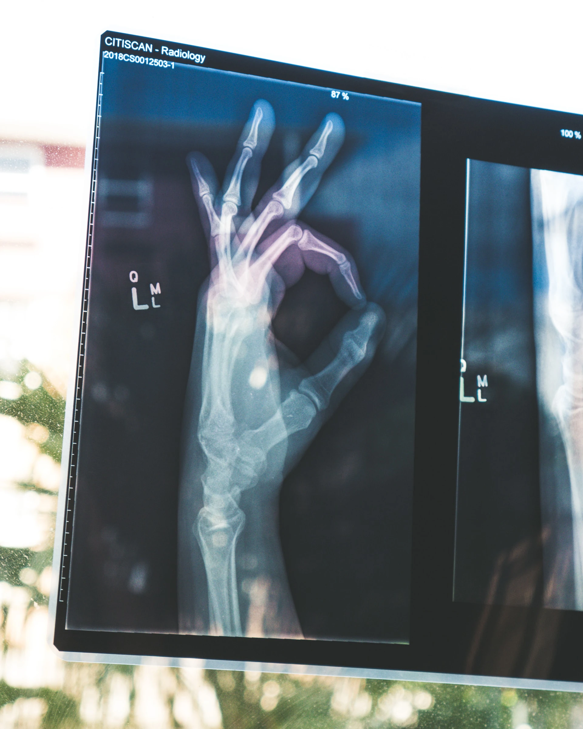 x-ray of a hand giving the okay symbol